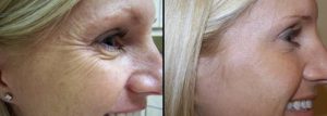 Treatment to Crow's feet with botox