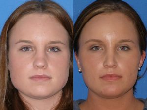 Reduction of square jaw with botox