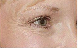 Crows feet before treatment with Botox