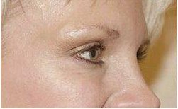 Crows feet after treatment with Botox