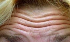 Forehead lines before treatment