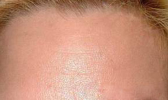 Forehead lines after treatment