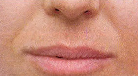 asolabial lines before treatment with Dermal filler