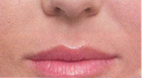 Nasolabial lines after treatment with Dermal filler