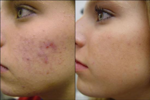 Before and after face peel
